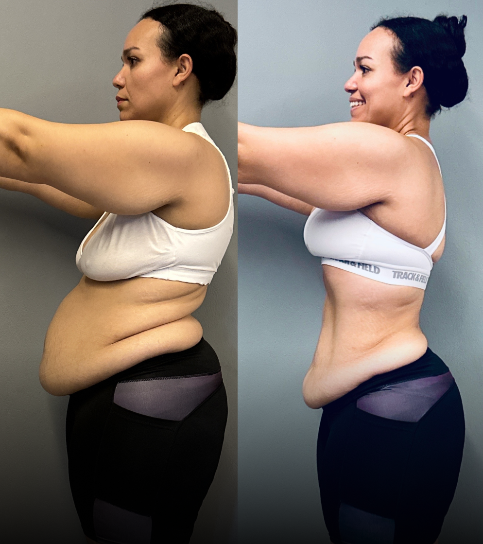 Denis Silva - antes e depois